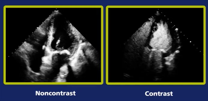 echocardiography cardiovascular imaging lantheus