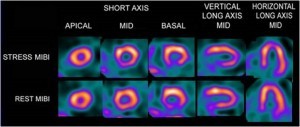 cardiolite_spect